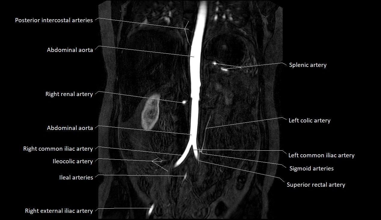 MRA Abdomen coronal anatomy image 21.webp